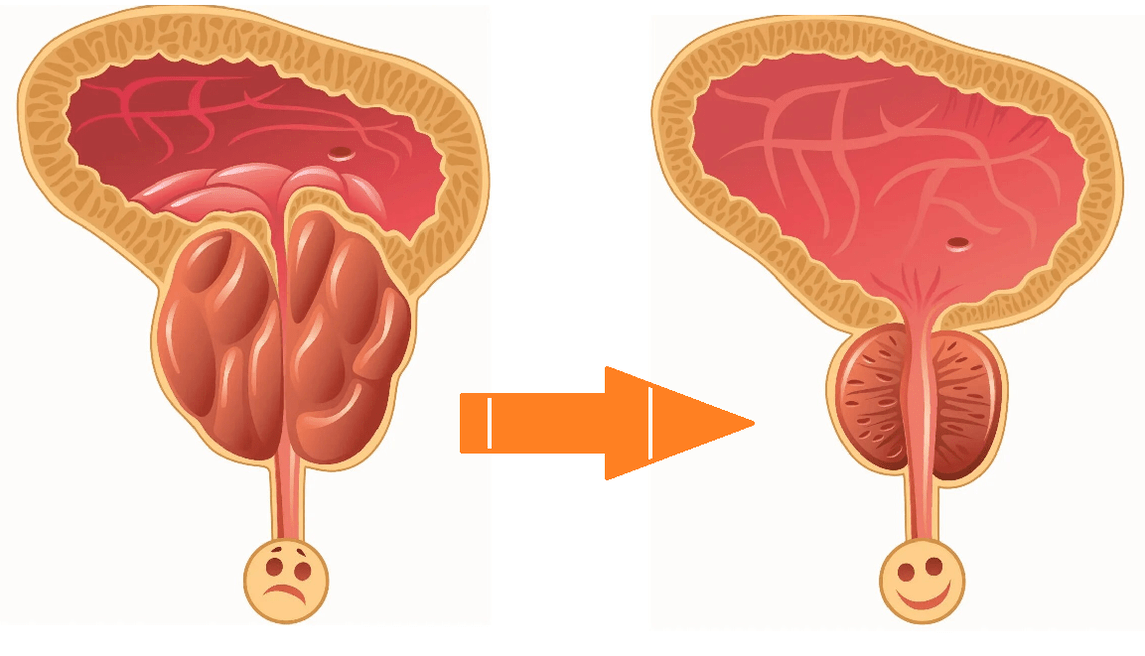 Acción Uromexil Forte sobre próstata con prostatitis y adenoma