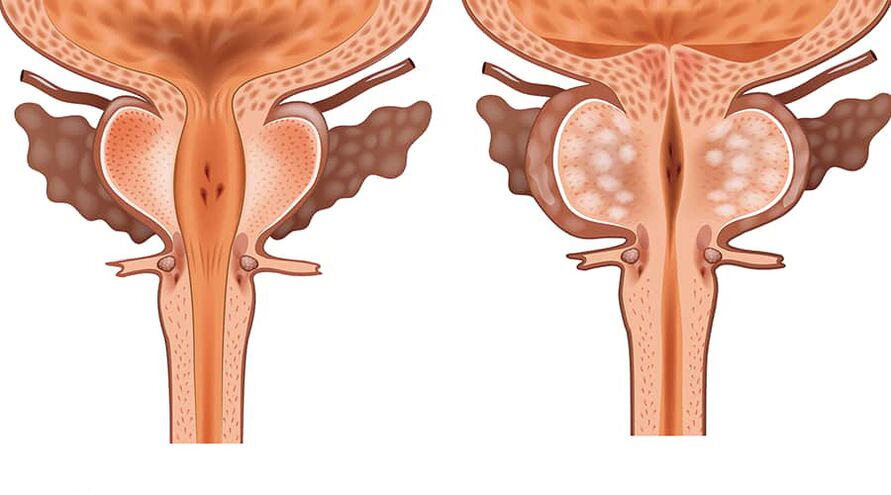 comparación de adenoma sano e inflamado