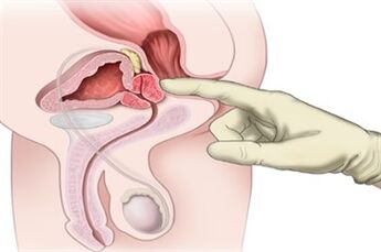 Masaje prostático para el tratamiento de la prostatitis crónica.