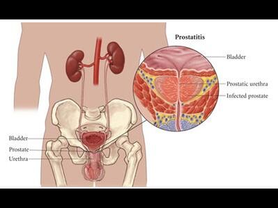 Prostatitis – inflamación de la glándula prostática
