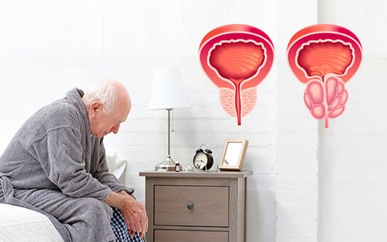 prostatitis en un hombre