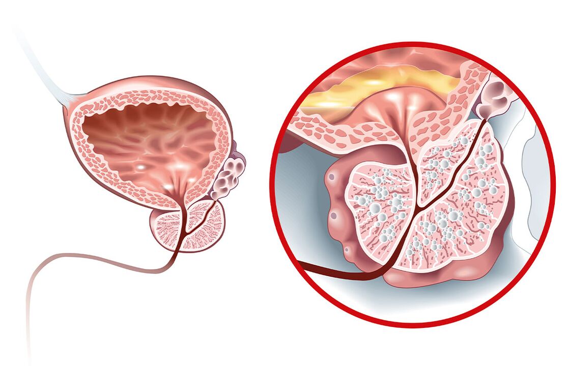 ¿Qué le sucede a la próstata con adenoma y prostatitis